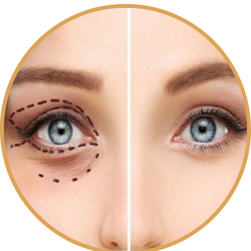 Upper and Lower Eyelid Blepharoplasty (Eyelid Lift)