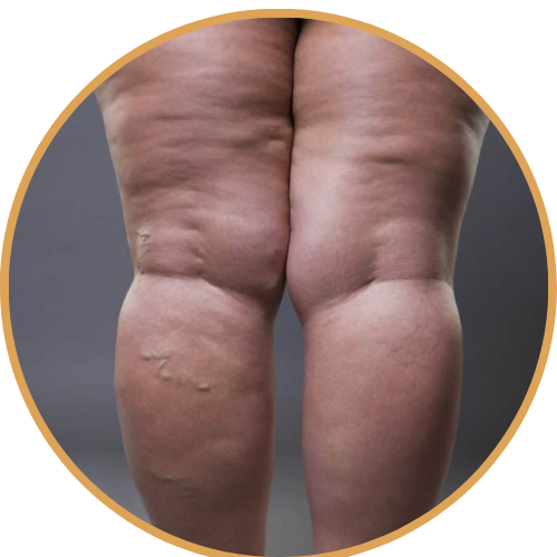 التخلص من الوزمة الشحمية ( الليبيديميا)