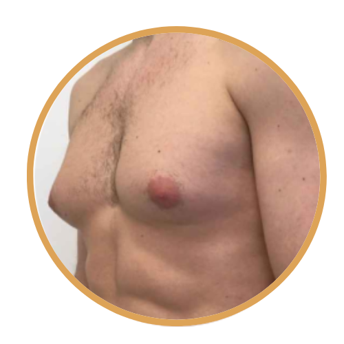 التخلص من التثدي للرجال