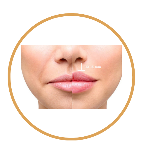 Lifting the upper lip and shortening the distance between the nose and the lips